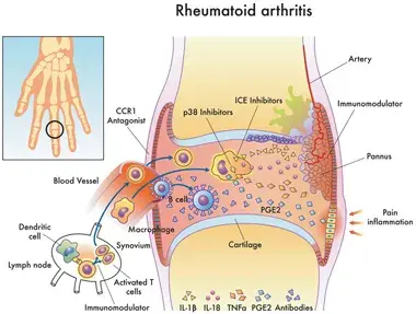 Rheumatoid Arthritis