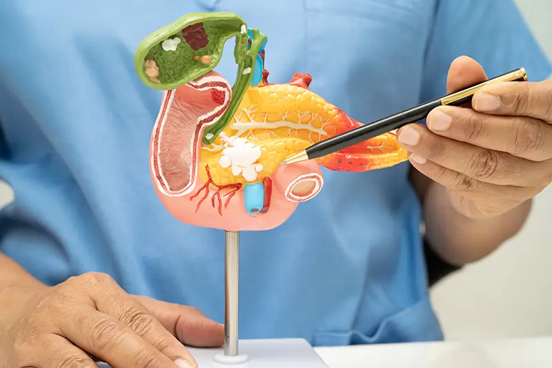 Curb Deadliness of Pancreatic Cancer Oncologists Must Help Curb Deadliness of Pancreatic Cancer