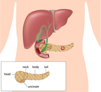 Pancreatic Cancer