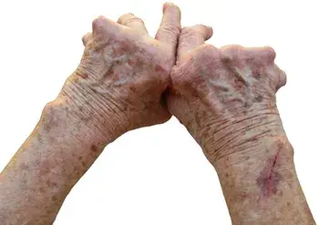 Rheumatoid Arthritis