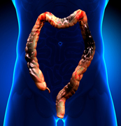 Routine Screening for Colorectal Cancer to Facilitate Early Diagnosis and Treatment