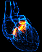 Mitral Valve Repair