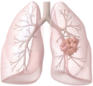 Routine Lung Cancer Screening – Important Vis a Vis Early Detection and Treatment