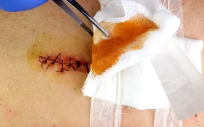 OASIS-C Documentation of Surgical Wounds for Medicare Reimbursement