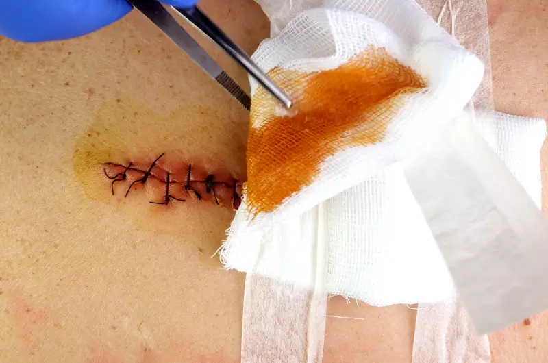 OASIS-C Documentation of Surgical Wounds OASIS-C Documentation of Surgical Wounds for Medicare Reimbursement