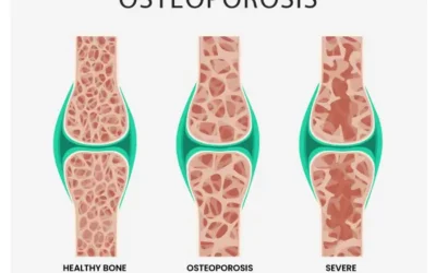 Osteoporosis Coding in 2015 – An Overview
