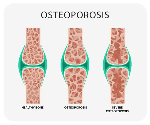 Osteoporosis Coding in 2015 Osteoporosis Coding in 2015 - An Overview