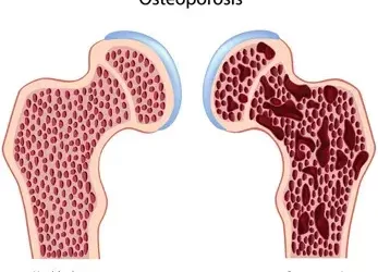 Osteoporosis Coding in 2015 – An Overview