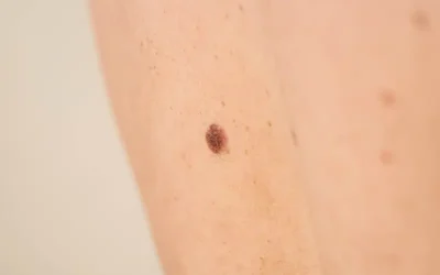 Squamous Cell Carcinoma – ICD-10-CM Coding Review for Medical Coding