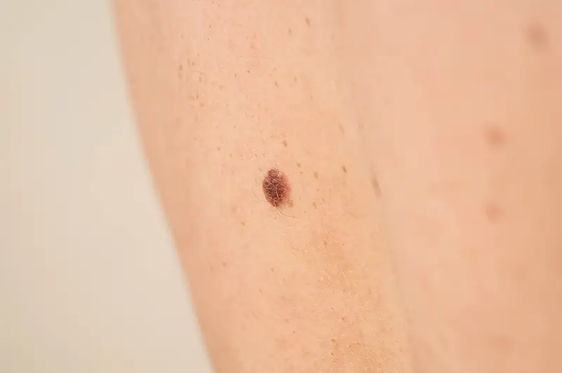 Squamous Cell Carcinoma