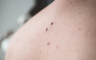 Squamous Cell Carcinoma – ICD-10-CM Coding Review for Medical Coding