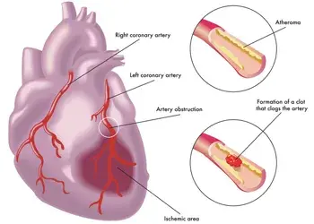 Myocardial Infarctions – ICD-10 Medical Coding and Documentation