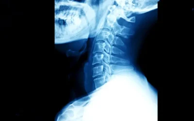 ICD-10 Coding for Cervical Disc Disorders and Displacements