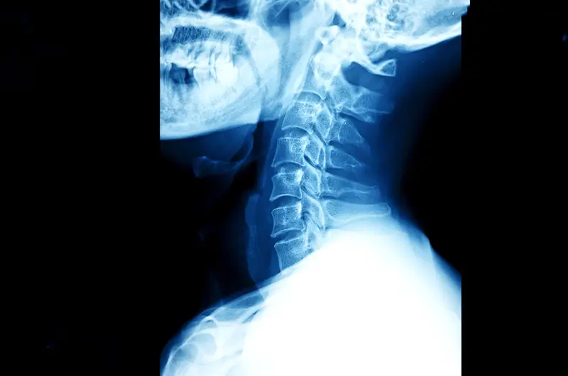 Coding for Cervical Disc Disorders ICD-10 Coding for Cervical Disc Disorders and Displacements