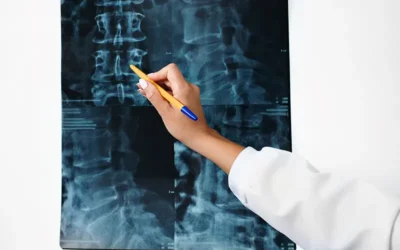 Vertebral Fracture Coding in ICD-10-CM