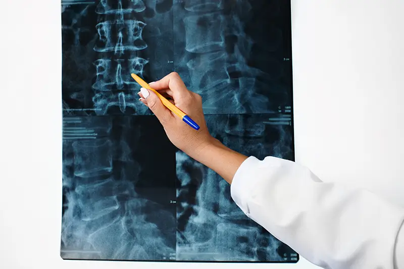 Vertebral Fracture Coding Vertebral Fracture Coding in ICD-10-CM