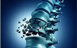 ICD-10 codes for Vertebral Fracture