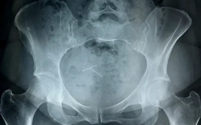 2017 CPT Code Changes for Pelvic Fracture – Focus on Complexity of Treatment