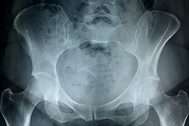 2017 CPT Code Changes for Pelvic Fracture – Focus on Complexity of Treatment