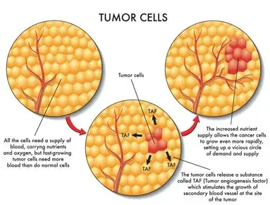 Treatment Tumors