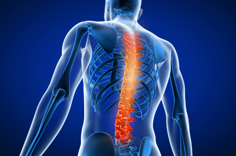 New CPT Codes and Coverage Criteria for Interlaminar Stabilization for Spinal Stenosis