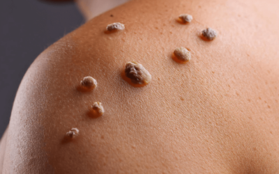 Learn About Warts – Types, Documentation with ICD-10 Codes