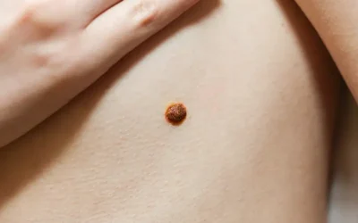 Learn About Warts – Types, Documentation with ICD-10 Codes