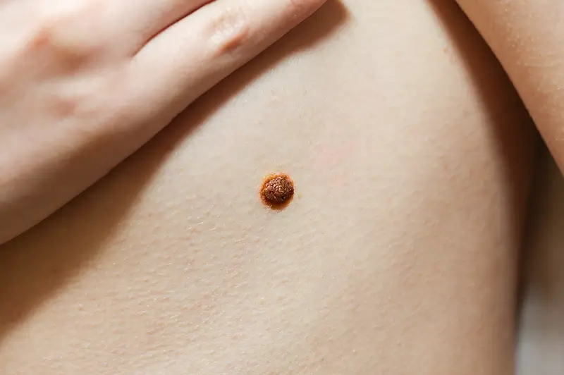 Learn About Warts - Types, Documentation with ICD-10 Codes