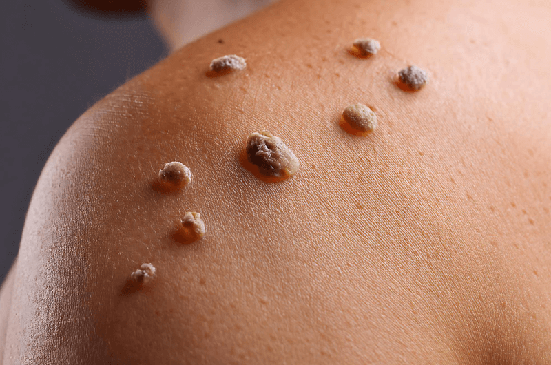 Learn About Warts – Types, Documentation with ICD-10 Codes