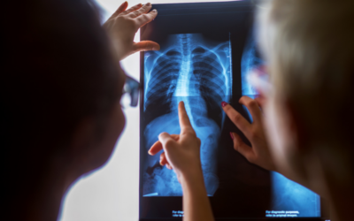 Medical Coding using ICD 10 for Rib Xrays