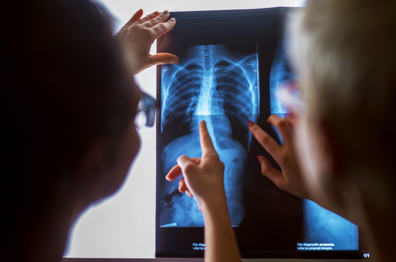 Medical Coding using ICD 10 for Rib Xrays