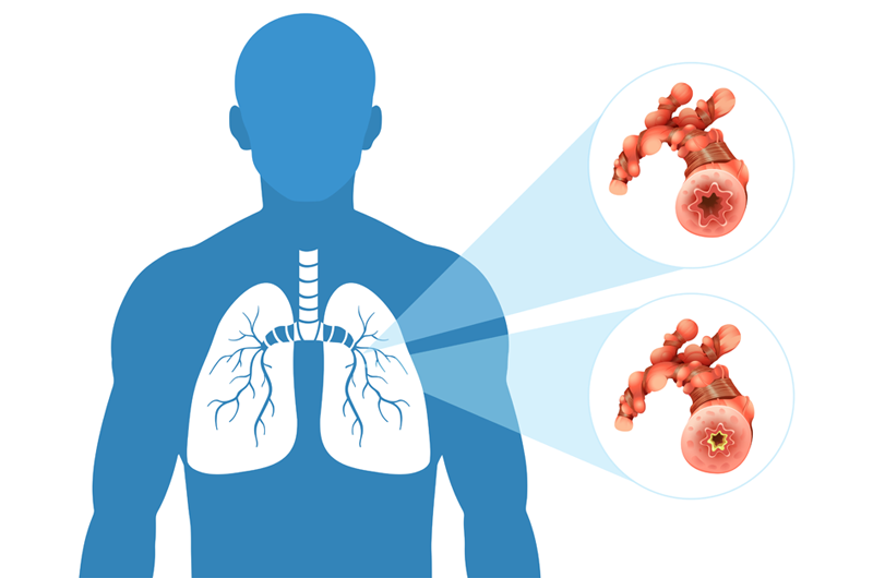 How to Code for COPD (Chronic Obstructive Pulmonary Disease)