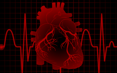 2018 ICD-10 Code Updates and Documentation Guidelines for Myocardial Infarction (MI)