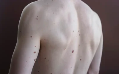 Sarcoma Coding Inaccurate in Most Cases – CTOS Annual Meeting