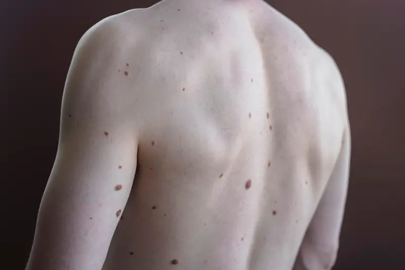 Sarcoma Coding Inaccurate in Most Cases Sarcoma Coding Inaccurate in Most Cases – CTOS Annual Meeting