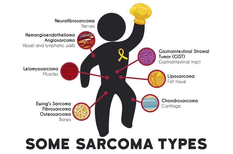 Sarcoma Coding Inaccurate in Most Cases - CTOS Annual Meeting