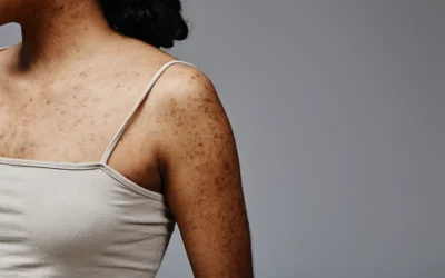 Medical Coding for Neurofibromatosis – What You Need to Know