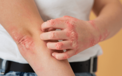 How To Report Systemic Lupus Erythematosus with the Correct ICD-10 Codes