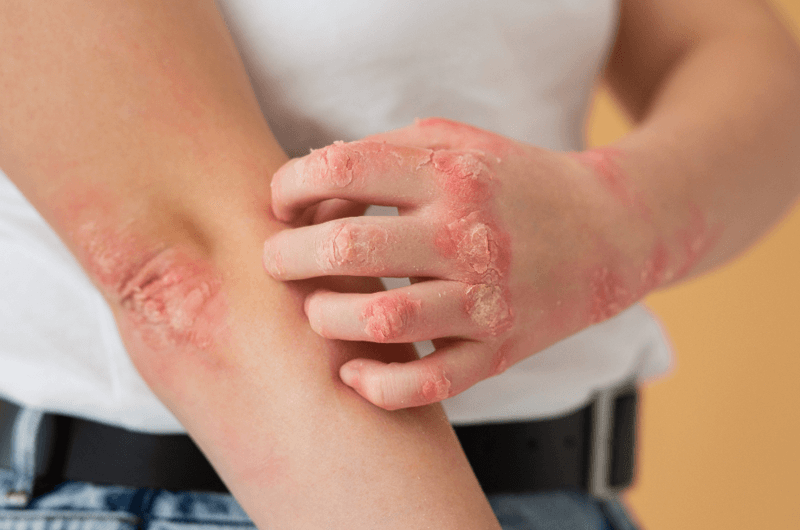How To Report Systemic Lupus Erythematosus with the Correct ICD-10 Codes
