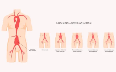 2018 CPT Coding Changes for Endovascular Repair of Abdominal Aorta and/or Iliac Arteries