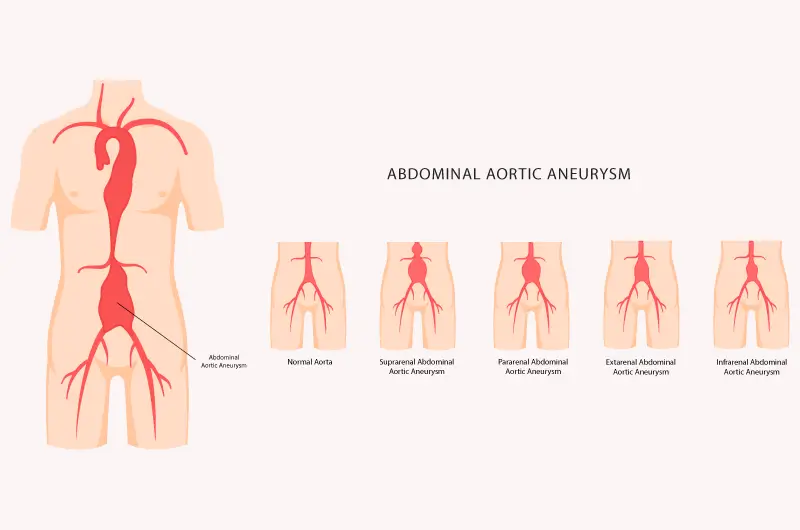 2018 CPT Coding Changes for Endovascular Repair of Abdominal Aorta and/or Iliac Arteries