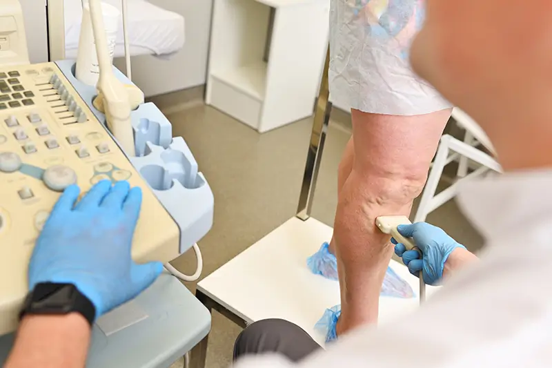 Coding Varicose Vein Treatment