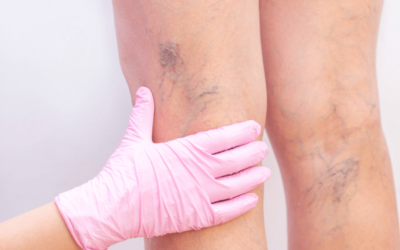 Coding Varicose Vein Treatment