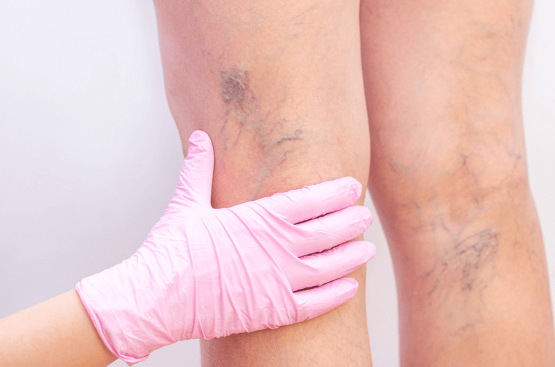 Coding Varicose Vein Treatment