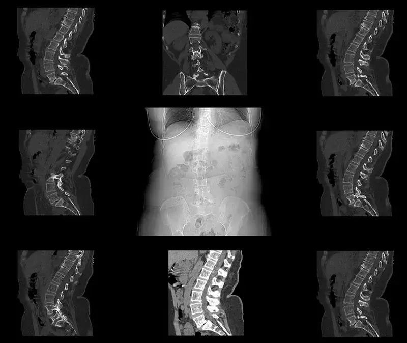 Documenting Spondylolisthesis with Accurate ICD-10 Codes