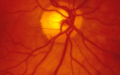 Coding for Diabetic Retinopathy