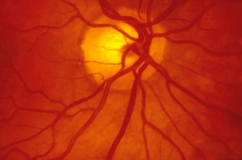 Diabetic Retinopathy Coding for Diabetic Retinopathy