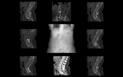 How to Document Spondylolisthesis with Accurate ICD-10 Codes