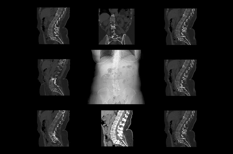 Document Spondylolisthesis with Accurate ICD-10 Codes
