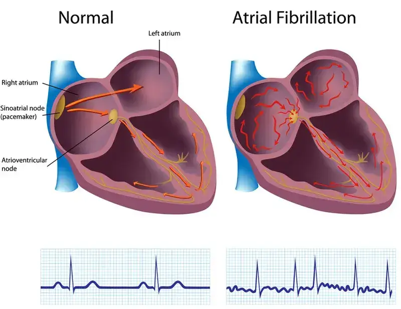 Coding Atrial Fibrillation Using ICD-10 and CPT Codes